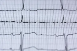 ECG Report For Detecting Heart Issues ECG Report For Detecting Heart Issues