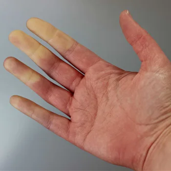 Raynauds Raynauds