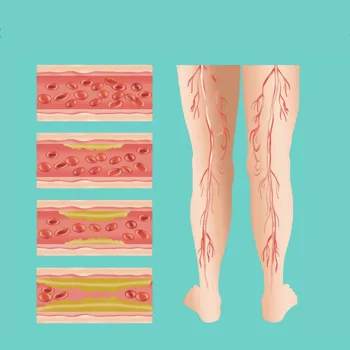 Senior Circulation and Peripheral Artery Disease Senior Circulation and Peripheral Artery Disease