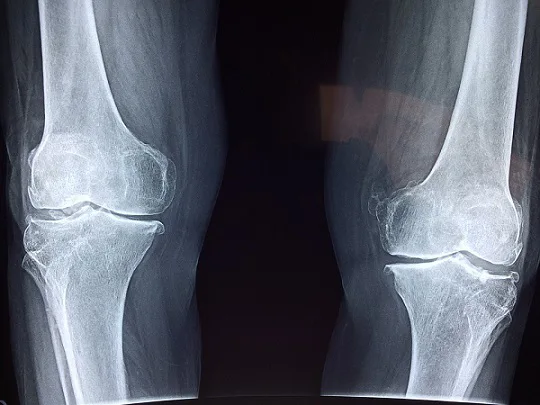 Knee Bone XRay Knee Bone XRay